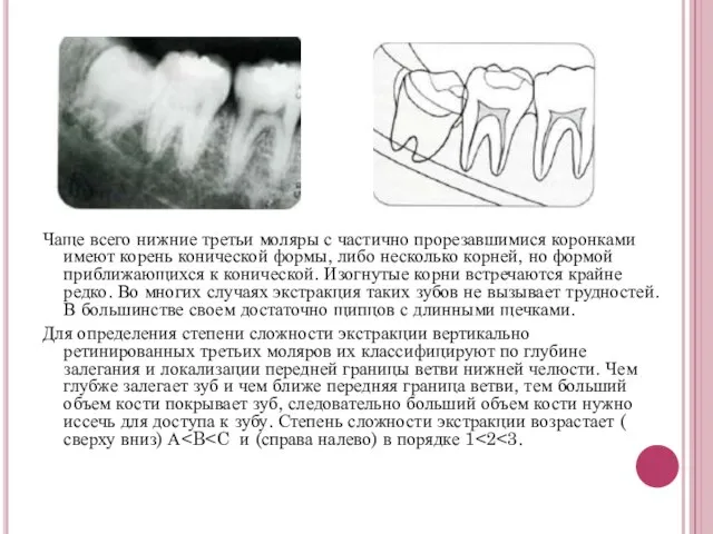 Чаще всего нижние третьи моляры с частично прорезавшимися коронками имеют корень конической