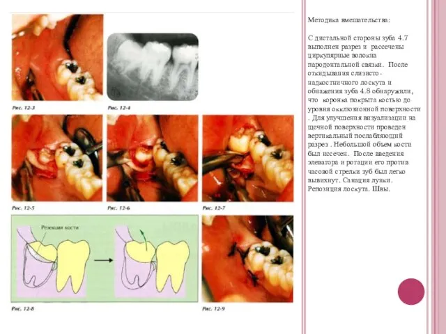 Методика вмешательства: С дистальной стороны зуба 4.7 выполнен разрез и рассечены циркулярные
