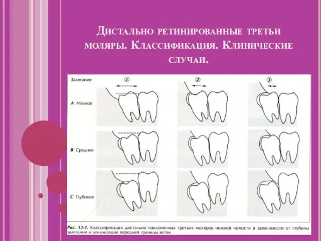 Дистально ретинированные третьи моляры. Классификация. Клинические случаи.