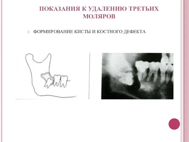 ФОРМИРОВАНИЕ КИСТЫ И КОСТНОГО ДЕФЕКТА ПОКАЗАНИЯ К УДАЛЕНИЮ ТРЕТЬИХ МОЛЯРОВ