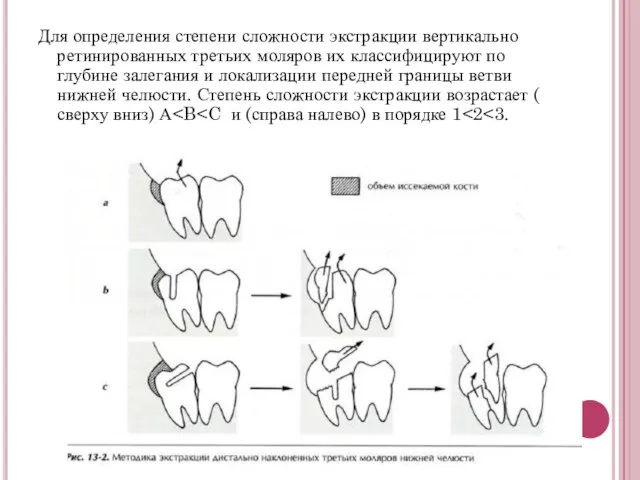 Для определения степени сложности экстракции вертикально ретинированных третьих моляров их классифицируют по