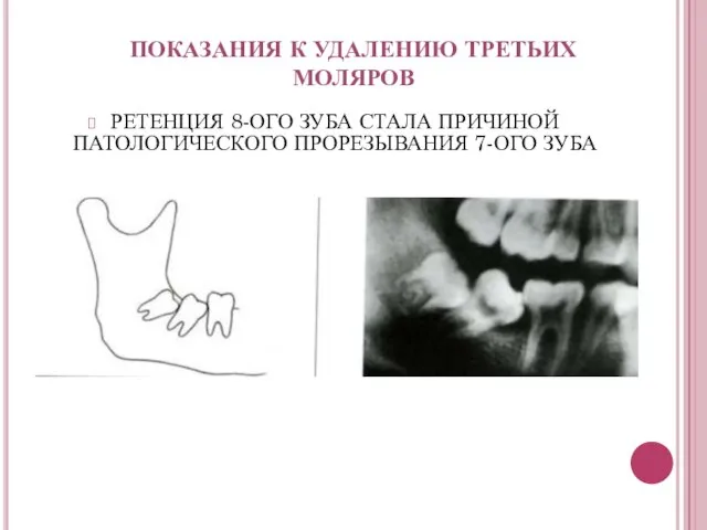 РЕТЕНЦИЯ 8-ОГО ЗУБА СТАЛА ПРИЧИНОЙ ПАТОЛОГИЧЕСКОГО ПРОРЕЗЫВАНИЯ 7-ОГО ЗУБА ПОКАЗАНИЯ К УДАЛЕНИЮ ТРЕТЬИХ МОЛЯРОВ