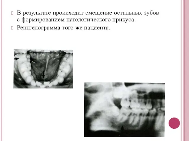 В результате происходит смещение остальных зубов с формированием патологического прикуса. Рентгенограмма того же пациента.