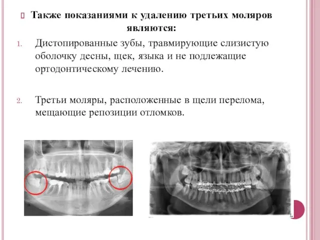 Также показаниями к удалению третьих моляров являются: Дистопированные зубы, травмирующие слизистую оболочку