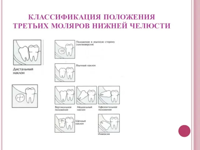 КЛАССИФИКАЦИЯ ПОЛОЖЕНИЯ ТРЕТЬИХ МОЛЯРОВ НИЖНЕЙ ЧЕЛЮСТИ