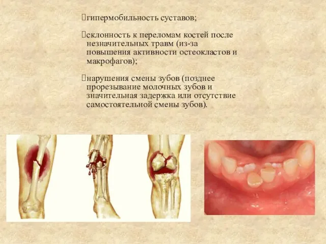 гипермобильность суставов; склонность к переломам костей после незначительных травм (из-за повышения активности