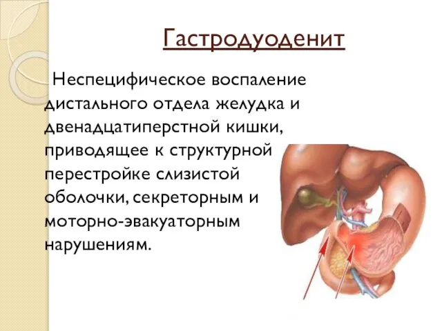 Гастродуоденит Неспецифическое воспаление дистального отдела желудка и двенадцатиперстной кишки, приводящее к структурной