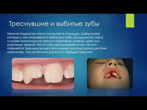 Треснувшие и выбитые зубы Многие подростки часто попадают в ситуации, в результате
