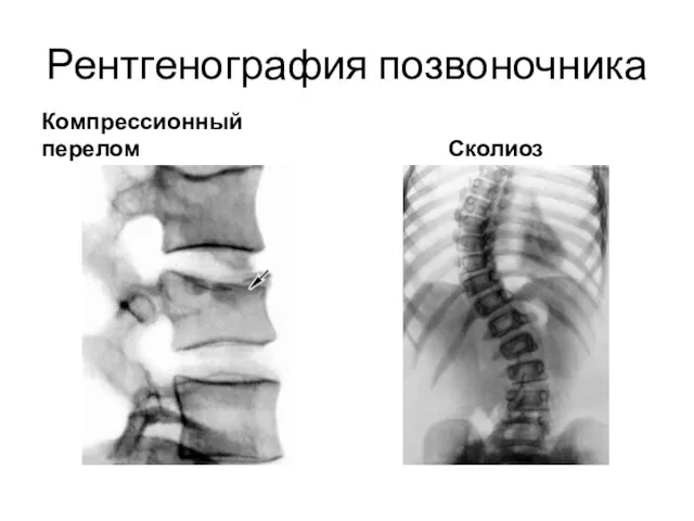 Рентгенография позвоночника Компрессионный перелом Сколиоз