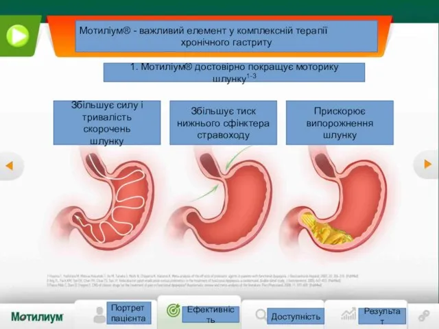 Портрет пацієнта Ефективність Доступність Результат Мотиліум® - важливий елемент у комплексній терапії