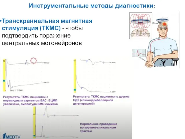 Инструментальные методы диагностики: Транскраниальная магнитная стимуляция (ТКМС) - чтобы подтвердить поражение центральных мотонейронов