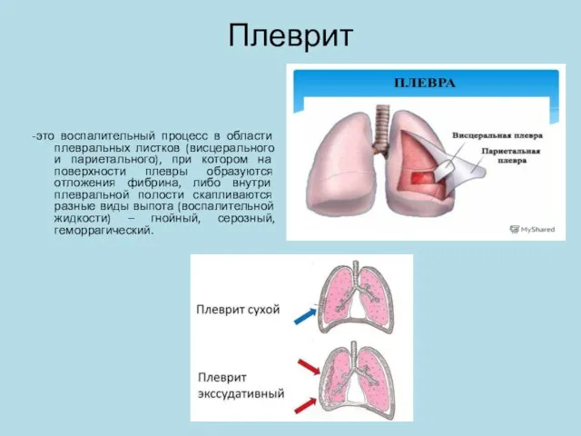 Плеврит -это воспалительный процесс в области плевральных листков (висцерального и париетального), при