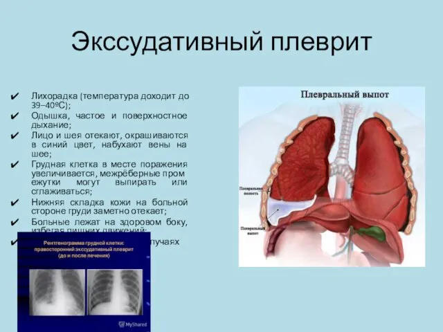 Экссудативный плеврит Лихорадка (температура доходит до 39–40ºС); Одышка, частое и поверхностное дыхание;