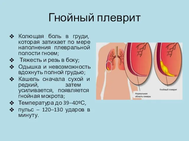 Гнойный плеврит Колющая боль в груди, которая затихает по мере наполнения плевральной