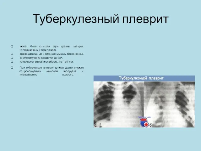 Туберкулезный плеврит может быть слышен шум трения плевры, напоминающий скрип снега. Трапециевидные