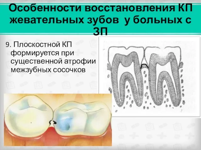 Особенности восстановления КП жевательных зубов у больных с ЗП 9. Плоскостной КП