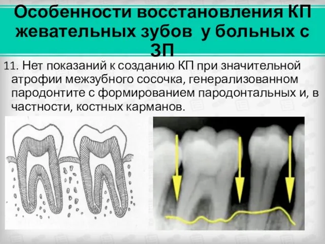 Особенности восстановления КП жевательных зубов у больных с ЗП 11. Нет показаний