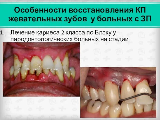 Особенности восстановления КП жевательных зубов у больных с ЗП Лечение кариеса 2