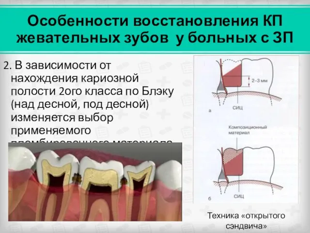 Особенности восстановления КП жевательных зубов у больных с ЗП 2. В зависимости