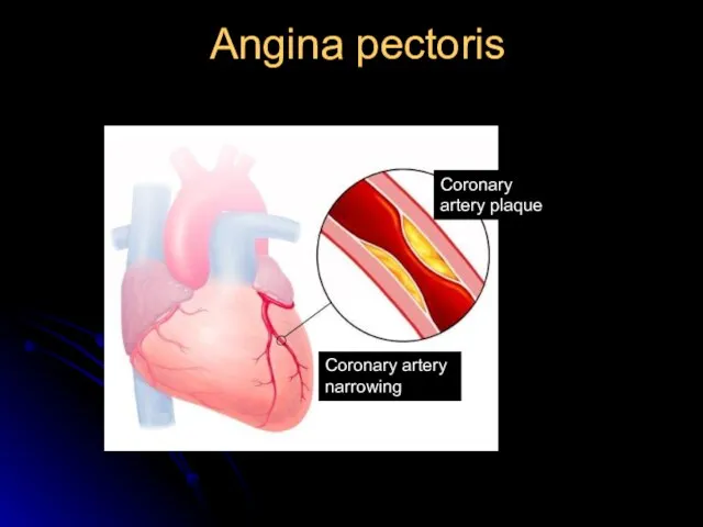 Angina pectoris Coronary artery narrowing Coronary artery plaque