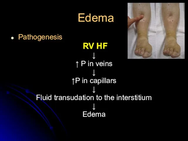 Edema Pathogenesis RV HF ↓ ↑ P in veins ↓ ↑Р in