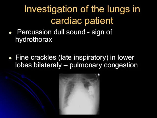 Investigation of the lungs in cardiac patient Percussion dull sound - sign