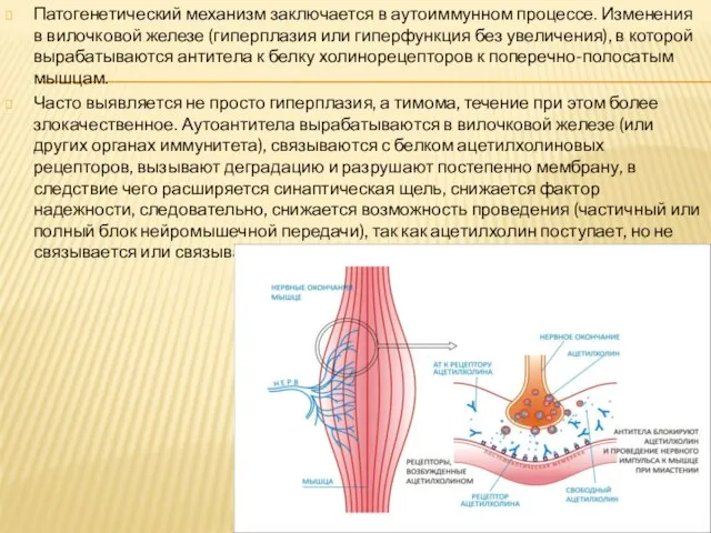 Патогенетический механизм заключается в аутоиммунном процессе. Изменения в вилочковой железе (гиперплазия или