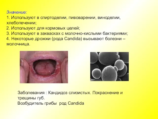 Заболевания : Кандидоз слизистых. Покраснение и трещины губ. Возбудитель грибы род Candida