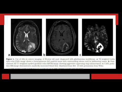 Barrett T, Brechbiel M, Bernardo M, Choyke PL. MRI of tumor angiogenesis.