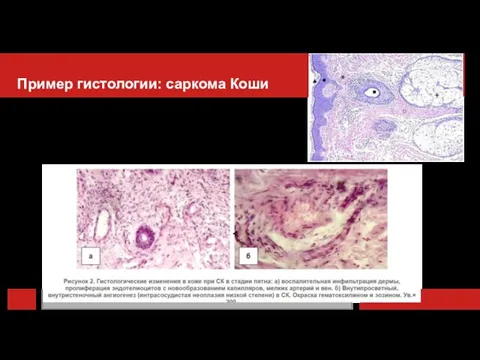 Пример гистологии: саркома Коши