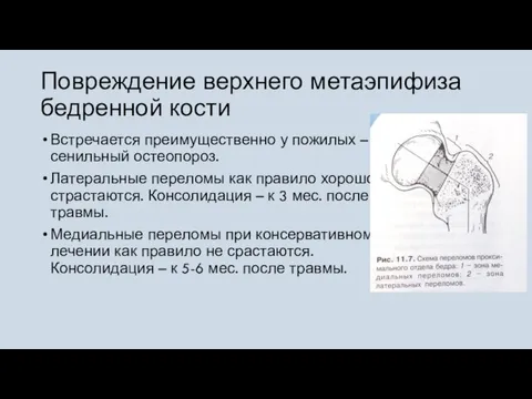 Повреждение верхнего метаэпифиза бедренной кости Встречается преимущественно у пожилых – сенильный остеопороз.