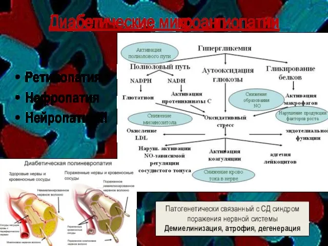 Диабетические микроангиопатии Ретинопатия Нефропатия Нейропатия!!! Патогенетически связанный с СД синдром поражения нервной системы Демиелинизация, атрофия, дегенерация