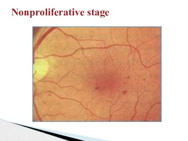Nonproliferative stage