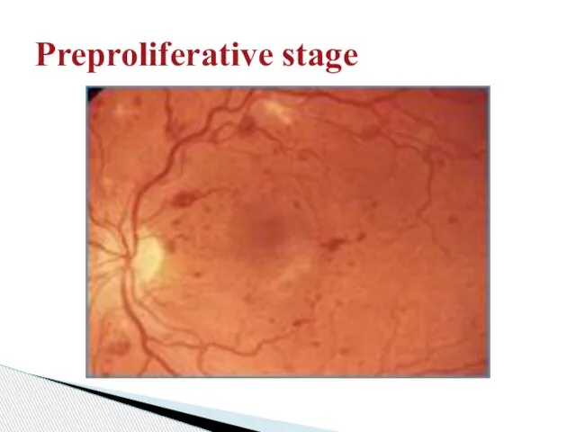 Preproliferative stage