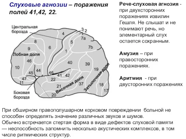 Слуховые агнозии – поражения полей 41,42, 22. При обширном правополушарном корковом повреждении