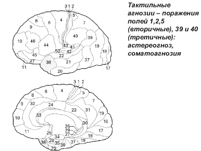 Тактильные агнозии – поражения полей 1,2,5 (вторичные), 39 и 40 (третичные): астереогноз, соматоагнозия