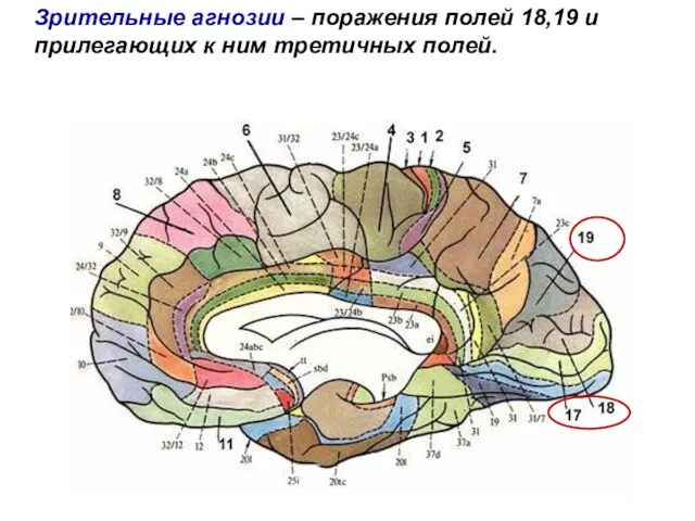 Зрительные агнозии – поражения полей 18,19 и прилегающих к ним третичных полей.