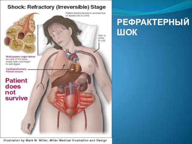 РЕФРАКТЕРНЫЙ ШОК