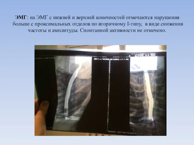 ЭМГ: на ЭМГ с нижней и верхней конечностей отмечаются нарушения больше с