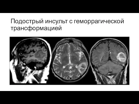 Подострый инсульт с геморрагической трансформацией