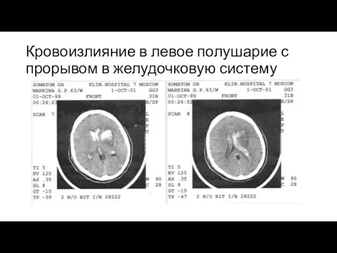 Кровоизлияние в левое полушарие с прорывом в желудочковую систему