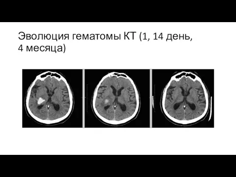 Эволюция гематомы КТ (1, 14 день, 4 месяца)