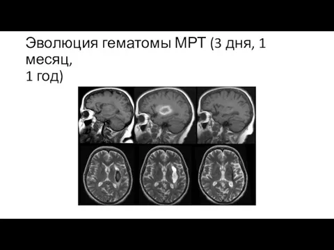 Эволюция гематомы МРТ (3 дня, 1 месяц, 1 год)