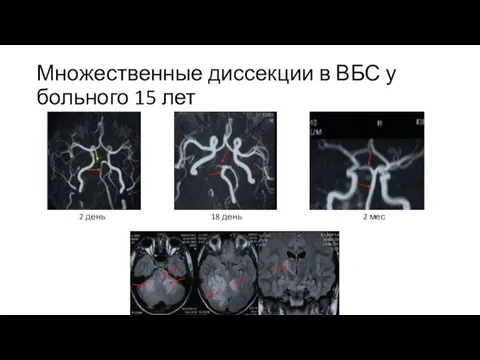 Множественные диссекции в ВБС у больного 15 лет 2 день 18 день 2 мес