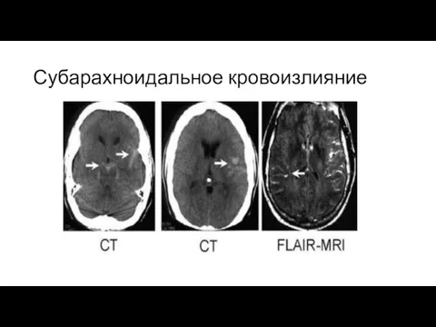 Субарахноидальное кровоизлияние