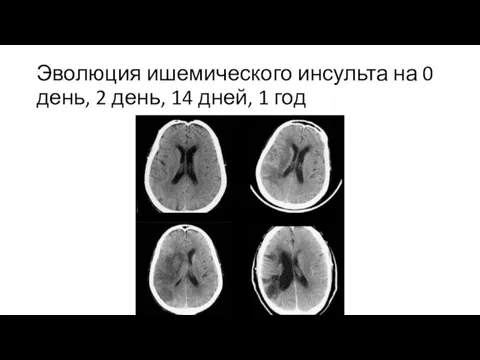 Эволюция ишемического инсульта на 0 день, 2 день, 14 дней, 1 год