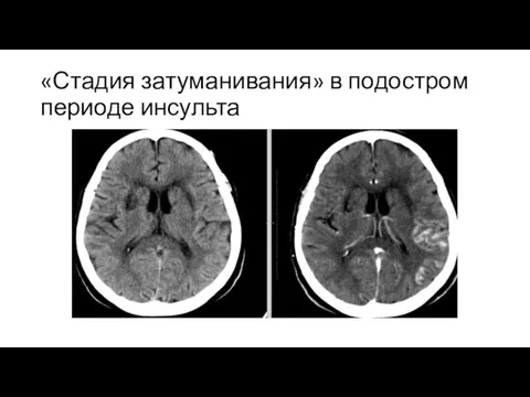 «Стадия затуманивания» в подостром периоде инсульта