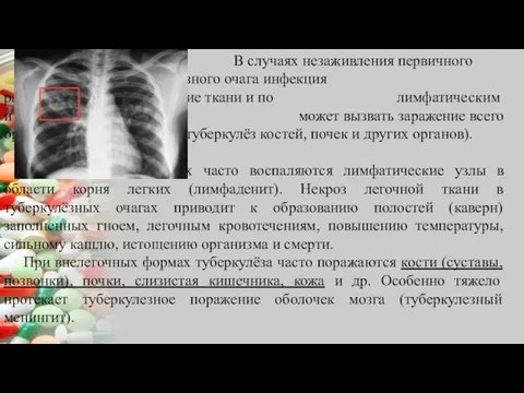 В случаях незаживления первичного туберкулезного очага инфекция распространяется на соседние ткани и