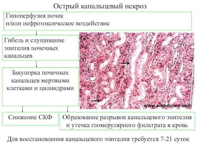 Острый канальцевый некроз Для восстановления канальцевого эпителия требуется 7-21 суток www.emedicine.com