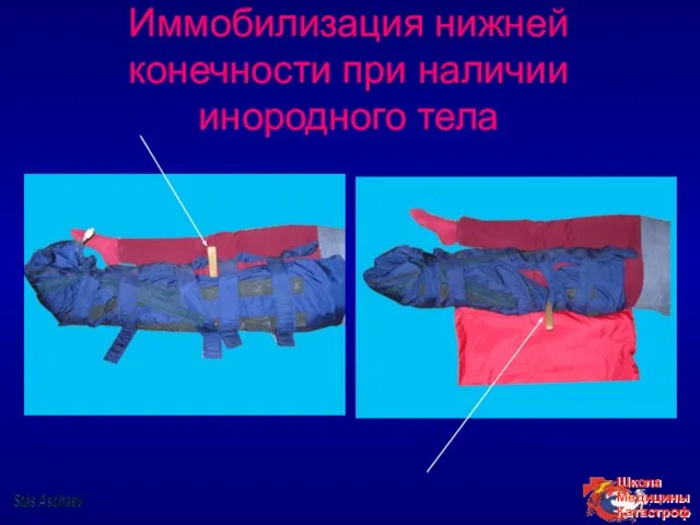 Иммобилизация нижней конечности при наличии инородного тела Stas Aschaev